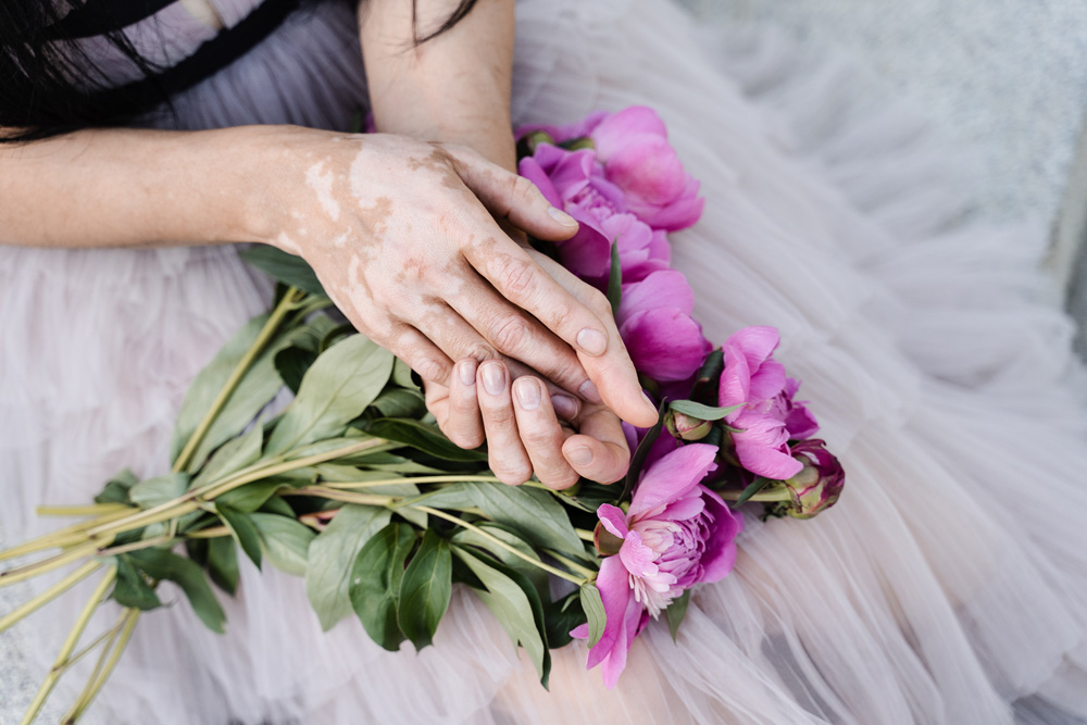 Hands with vitiligo skin pigmentation and bouquet of flowers peonies. Skin seasonal diseases. Hands with vitiligo skin pigmentation and bouquet of flowers peonies