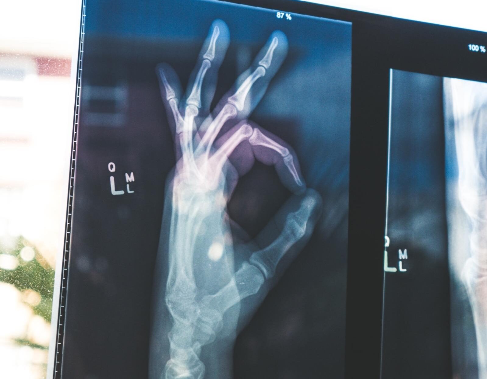 xray of hand making ok sign