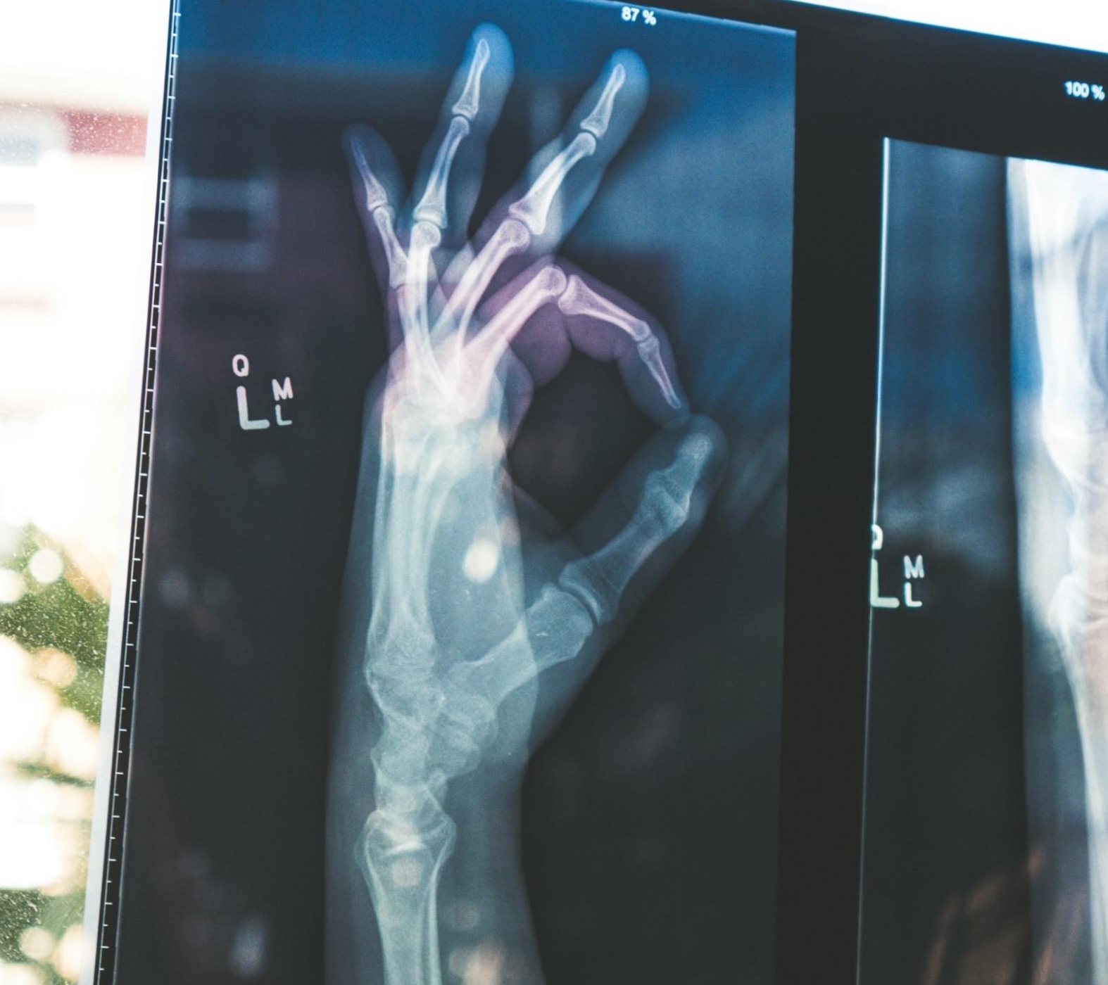 okay hand xray okay hand xray